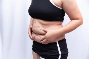 Benefits of Obesity and Plastic Surgery in Egypt