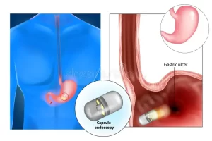 the difference between capsule endoscopy and gastroscopy