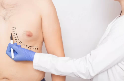 علاج التثدي عند الرجال بالليزر
